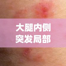 大腿内侧突发局部过敏痒，大腿内侧皮肤过敏 